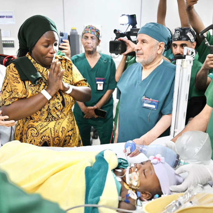 نجاح عملية فصل التوأم الملتصق التنزاني نانسي ونايس